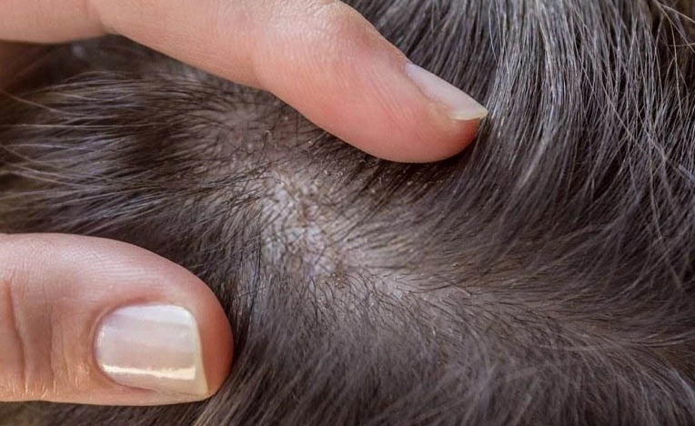Chân Tóc Có Hạt Trắng: Nguyên Nhân, Cách Xử Lý & Phòng Ngừa Hiệu Quả Chân tóc có hạt trắng do gàu