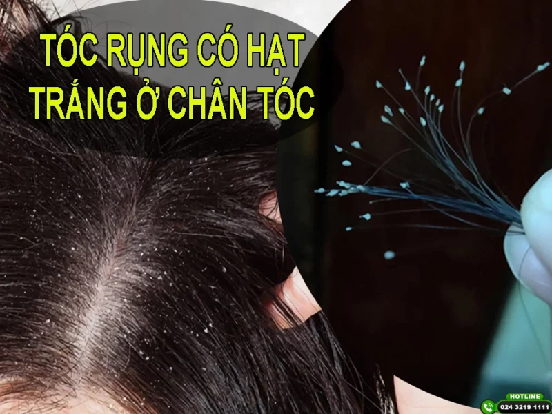 Chân Tóc Có Hạt Trắng: Nguyên Nhân, Cách Xử Lý & Phòng Ngừa Hiệu Quả Da đầu khỏe mạnh, không có hạt trắng ở chân tóc